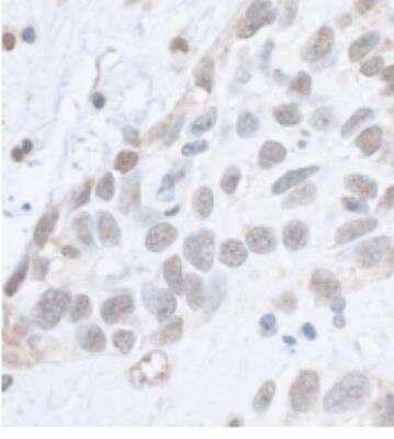 Immunohistochemistry-Paraffin: SMC1 [p Ser966] Antibody [NB100-206] - Human breast carcinoma. Antibody: Affinity purified rabbit antiPhospho SMC1 (S966)  used at a dilution of 1:1,000 (1ug/ml). Detection: DAB